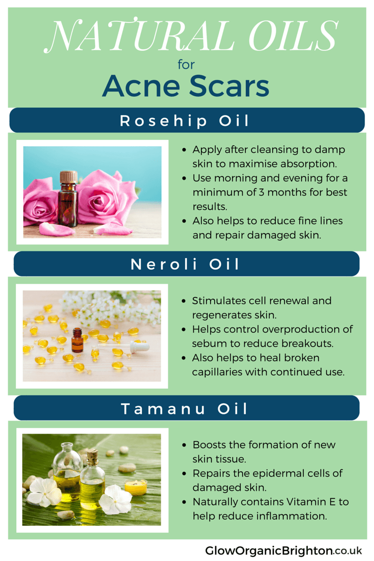 Natural Oils for Acne Scars