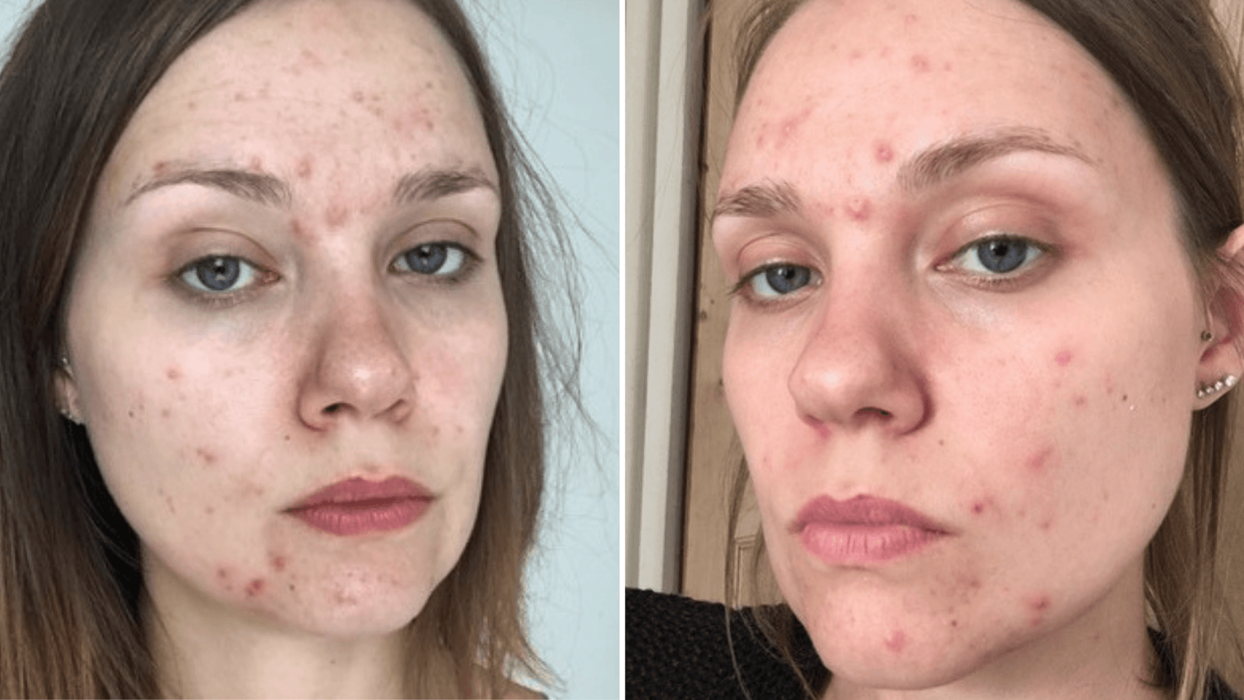 Acne Awareness Month - Our Founder's Acne Journey