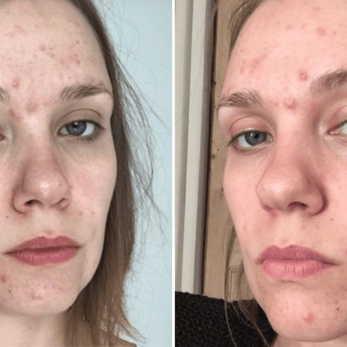 Acne Awareness Month - Our Founder's Acne Journey